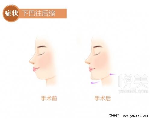 李志海院長:國內(nèi)下頜角手術(shù)也能做出“韓范兒”臉