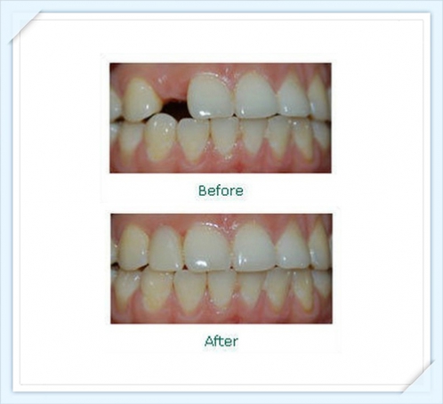 說說種植牙那些事兒 徐連來院長(zhǎng)專訪記