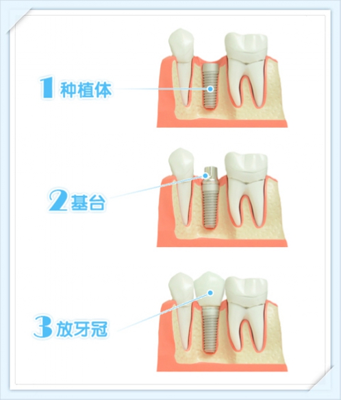 說說種植牙那些事兒 徐連來院長(zhǎng)專訪記
