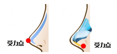 鼻整形醫(yī)生<!--<i data=20240703-sp></i>-->:美鼻不等于隆鼻