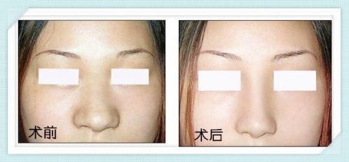 劉薔醫(yī)生鼻整形手術(shù)案例1 劉薔醫(yī)生鼻整形手術(shù)案例1