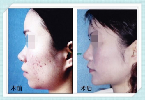 劉薔醫(yī)生鼻整形手術(shù)案例2 劉薔醫(yī)生鼻整形手術(shù)案例2