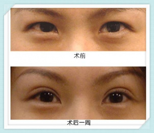 劉薔醫(yī)生雙眼皮手術(shù)案例 劉薔醫(yī)生雙眼皮手術(shù)案例