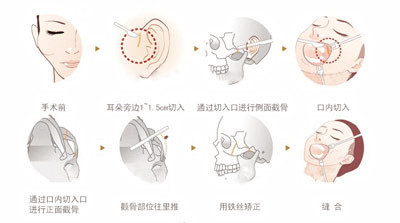 <!--<i data=20240703-sp></i>-->:只做顴骨手術(shù)也能讓臉變年輕