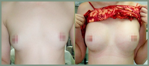 謝衛(wèi)國院長:水滴形隆胸假體不一定適合你!