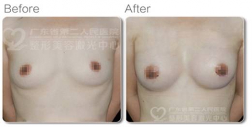 羅盛康:選對醫(yī)院和醫(yī)生 隆胸安全更有效