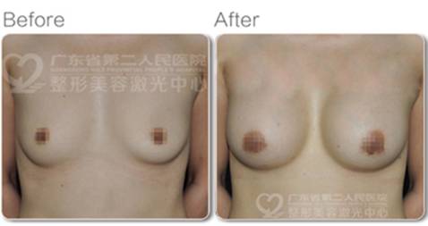 羅盛康:選對醫(yī)院和醫(yī)生 隆胸安全更有效