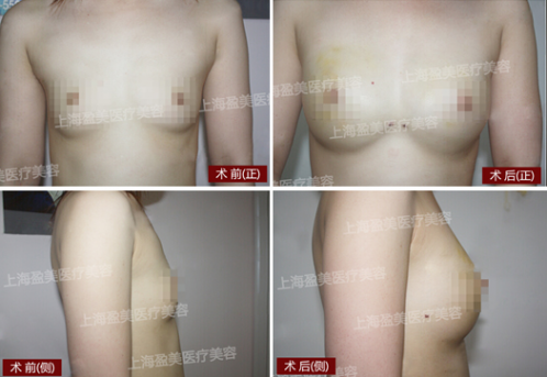 楊璐：自體脂肪不是注射越多 成活就越多