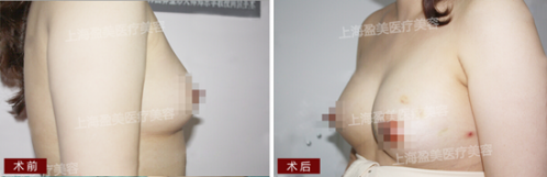 楊璐：自體脂肪不是注射越多 成活就越多