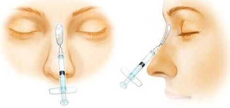 沒假體沒玻尿酸也能隆鼻？！我和小伙伴們都驚呆了