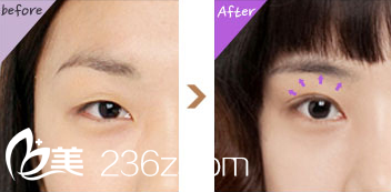 雙眼皮對(duì)比圖