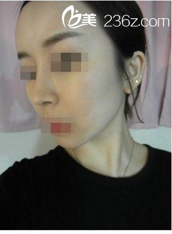 自體脂肪豐額頭