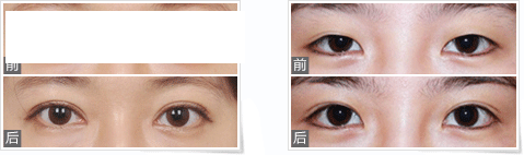 雙眼皮優(yōu)惠活動(dòng)