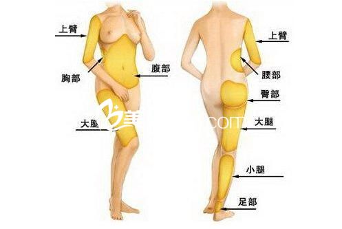 吸脂瘦身你需要知道哪些事？
