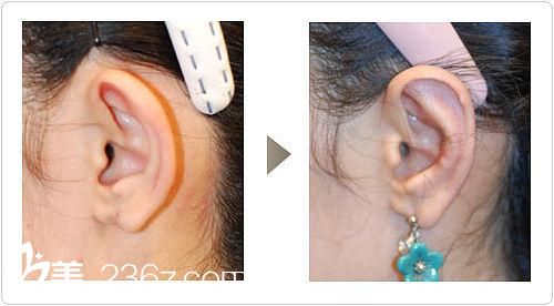 招風(fēng)耳矯正