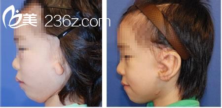 小耳畸形矯正術(shù)