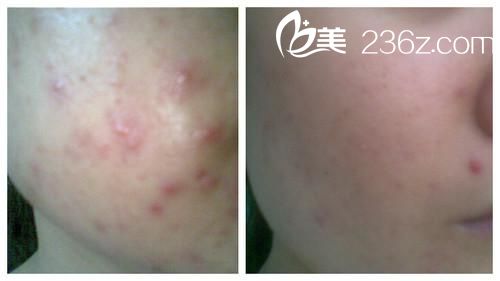 激光去痘手術(shù)前后對(duì)比圖