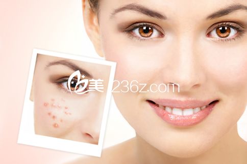 激光去痘印團(tuán)購