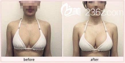 韓式隆胸價(jià)格