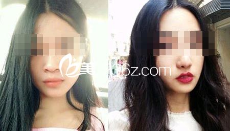 蒜頭鼻整形前后對(duì)比照片