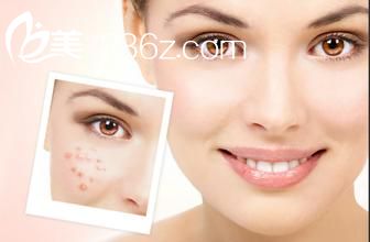 北京點(diǎn)陣激光去痘印有副作用嗎？