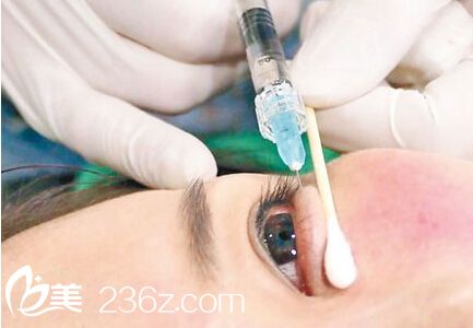 玻尿酸注射填充淚溝的步驟是怎樣的？