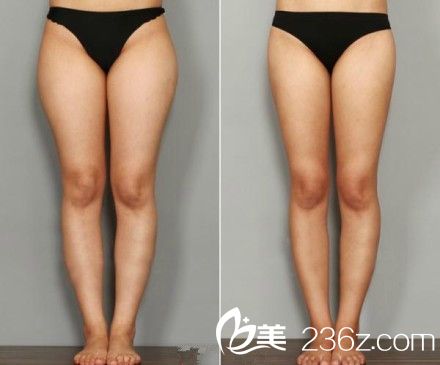 腿部吸脂也有后遺癥