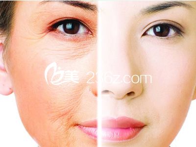 注射伊維蘭除皺有哪些優(yōu)點(diǎn)