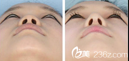 鼻子太短怎么辦