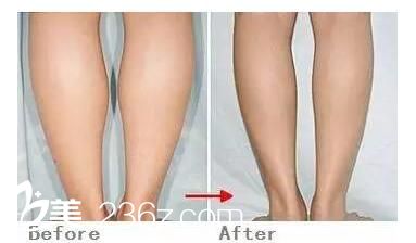 瘦腿效果對比圖
