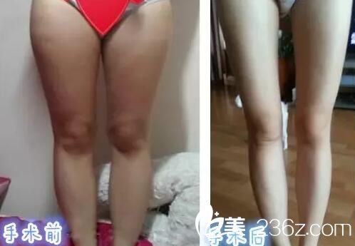 吸脂瘦腿對比效果圖