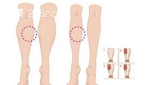 注射瘦腿示意圖