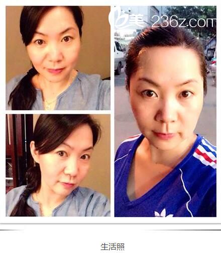 一次治療后生活照