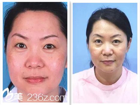 一次治療前后對比圖