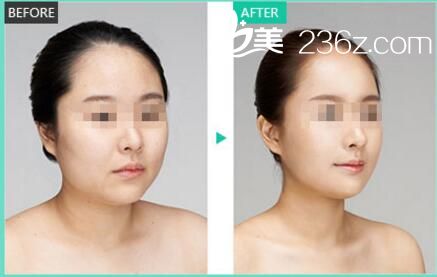 自體脂肪填充案例