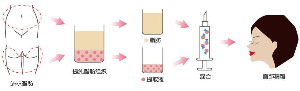 自體脂肪填充過(guò)程