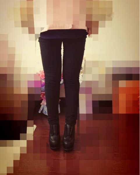 剛做的大腿和臀部吸脂，直接上圖啦!!!原來(lái)的大肥腿。下午先掛