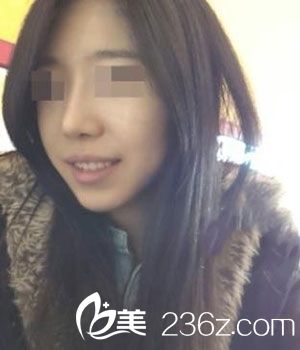 　　　　先來一張術前的照片哈　　　　從側面看是不是好像木有鼻