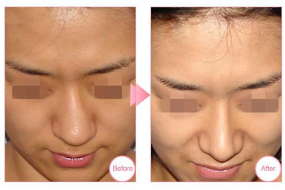 鼻中隔偏曲矯正術(shù)