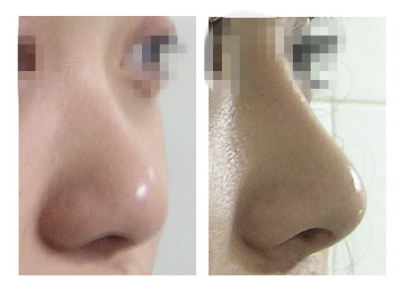 耳軟骨隆鼻安全嗎